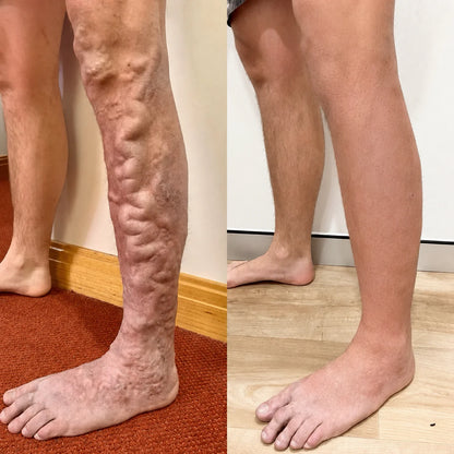 Gel contre les varices et les jambes gonflées