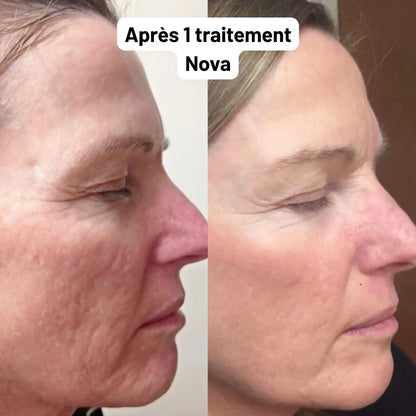 Nova Système Micro-Infusion