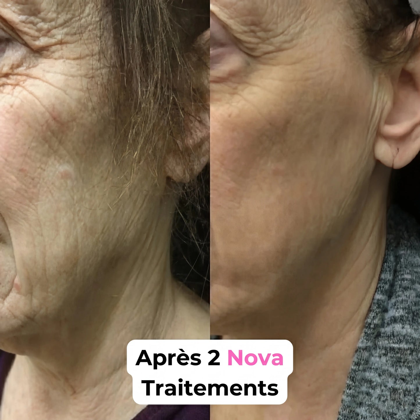 Nova Système Micro-Infusion