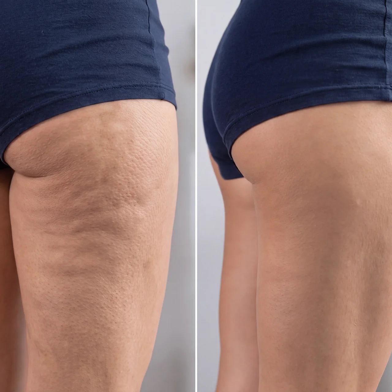 Bienencreme gegen Cellulite