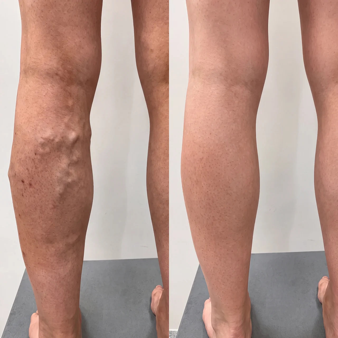 Gel contre les varices et les jambes gonflées