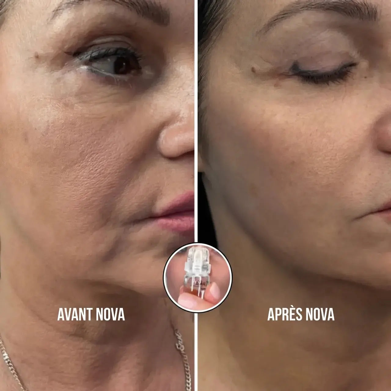 Nova Système Micro-Infusion